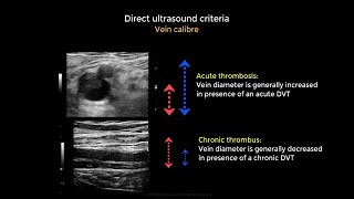 Acute and chronic Deep vein thrombosis Vein diameter variation [upl. by Flin]