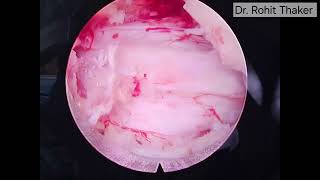 Interlaminar Endoscopic Decompression Lumbar Canal Stenosis L45 Dr Rohit Thaker spine doctor [upl. by Tillie]