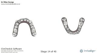 Invisalign animation showing tooth movement [upl. by Nwavahs]