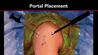 Calcific Tendonitis Treatment  Arthroscopic Rotator Cuff Repair  Shoulder Surgeon [upl. by Houlberg]