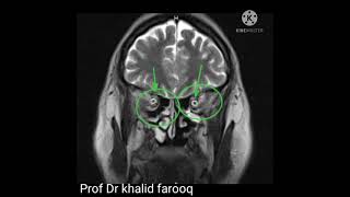 Benignidiopathic intracranial hypertension [upl. by Conn]