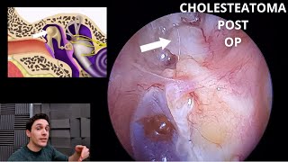 After Cholesteatoma Surgery Still A Problem With Effusion [upl. by Aneelas]