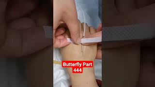 Butterfly  Part 444  Scalping shorts viral youtubeshorts medical hospital [upl. by Wolfgang]