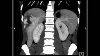 Abdomen Liver Cavernous Hemangioma of the Liver8 of 9 [upl. by Gerrard554]