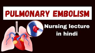 Pulmonary Embolism in hindi  cause pathophysiology symptoms management  nursing lecture [upl. by Pelagi]