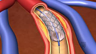 Animation  Coronary stent placement [upl. by Christie]