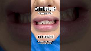 ZAHNLÜCKEN schließen Ohne Schleifen mit der Flowable Injection Technique zahnlücke flowable [upl. by Nylanej]