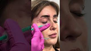 Full Face Botulinum Toxin Injection by Expert Doctor Prepare to Be Amazed [upl. by Erwin753]