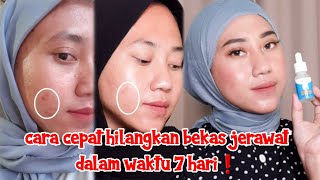 REVIEW FADE ACNE MARKS SERUM DERMIES  HILANGKAN BEKAS JERAWAT KEHITAMAN DALAM WAKTU 7 HARI [upl. by Eisoj]