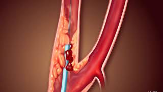 Voyage Through the Veins An Animated Exploration of Carotid Angioplasty and Stenting [upl. by Leotie483]