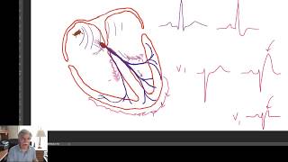 Trifascicular Block Explained Simply – WHY WHEN HOW [upl. by Hanzelin]