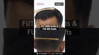 Best Hair Transplant Results by Dr Suneet Soni at Medispa Hair Transplant [upl. by Yltneb552]