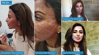 CO2 Laser Resurfacing treatment at London Laser Clinic [upl. by Marlin291]