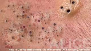 How to Get Rid Blackheads And Whiteheads On Face Easy Remedies [upl. by Johm]