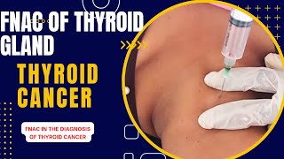 FNAC in the Diagnosis of Thyroid Gland।। থাইরয়েড গ্লান্ড কীভাবে FNAC পরীক্ষা করা হয়।। [upl. by Pressey62]