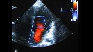 Severe Mitral Valve Prolapse [upl. by Schwerin389]