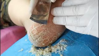 FOOT RASPING DAY Callus removal on foot with EPPK Keratoderma Hyperkeratosis  Jun 6 2023 [upl. by Laeira749]