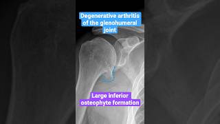 Degenerative arthritis DJD of the shoulder shoulder arthritis radiology [upl. by Niel792]