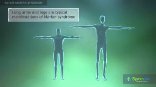 Marfan Syndrome About [upl. by Roch]