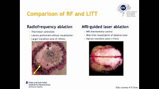 LITT for mesial temporal lobe epilepsy by Chengyuan Wu [upl. by Anikehs]