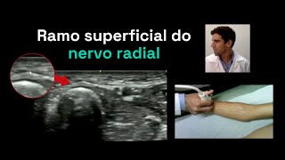 Ramo superficial do nervo radial é possível ao ultrassom [upl. by Aicilihp]