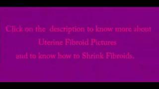 Uterine Fibroid Pictures [upl. by Ashlie]