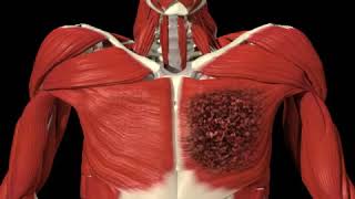 Lobular Carcinoma and management mastectomy lumpectomy Quadrantectomy [upl. by Immak]