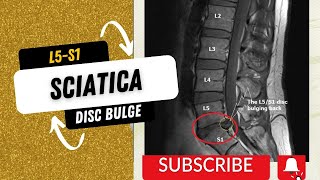 L5S1 Disc bulgeSciatica pain Treatment [upl. by Eelsha]