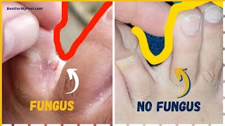 How to GET RID of the Athletes Foot Fungus Forever This is how I did it at home [upl. by Niknar788]