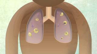 How The Body Reacts To Tuberculosis [upl. by Rodman]