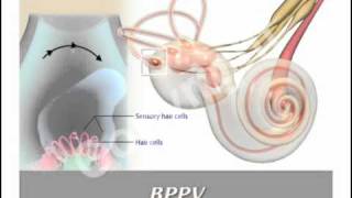 BPPV and Epleys Maneuver [upl. by Cotsen31]