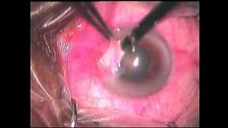 Pterygium Excision with AMG [upl. by Joacima]