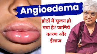 मेरे होंठ सूज गए Angioedema  Swelling of lips and face ANGIOEDEMA Causes Symptoms and Treatment [upl. by Sisson496]