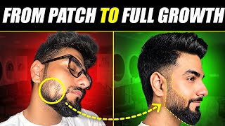 This is How I Treated a DANGEROUS Beard Patch 😰 Alopecia Areata Treatment  The Gabru Life [upl. by Rednirah944]