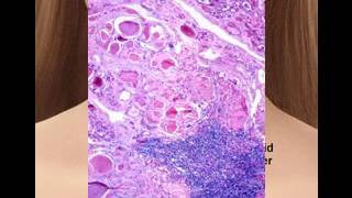 Anaplastic thyroid cancer pictures [upl. by Quartus]