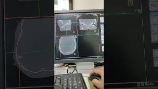 MastoiditisRtCt scan of Mastoid [upl. by Dilan925]