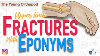 Named Fractures UPPER LIMB Fractures with EPONYMS NEET PG The Young Orthopod [upl. by Anileme494]