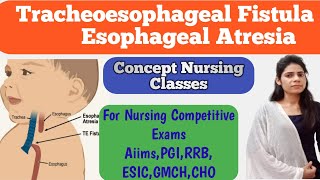 Tracheoesophageal Fistula and Esophageal Atresia pediatrics important topic [upl. by Tarrance629]