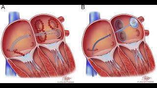 Atrial Fibrillation Ablation Procedure  Pulmonary Vein Isolation Simple Solution [upl. by Osrock319]