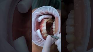 Porcelain veneers for gap teeth veneers dental dentist [upl. by Evelyn584]