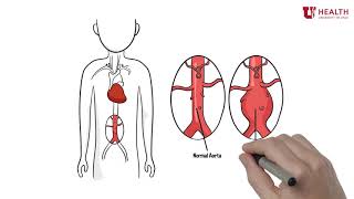 What is an Abdominal Aortic Aneurysm [upl. by Bohannon472]