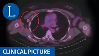 COVID19 mRNA vaccinerelated adenopathy mimicking metastatic melanoma [upl. by Celia]