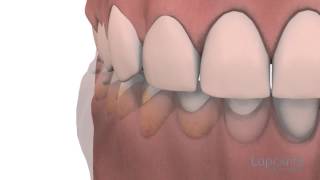 Gingivoplastie et gingivectomie  Centres dentaires Lapointe [upl. by Nospmis735]