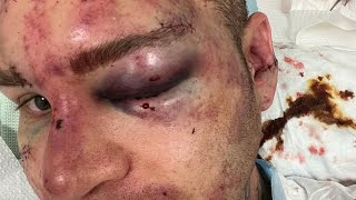 Bareknuckle fighters ear gets split in half during BKFC 37 bout  Chaz Wasserman vs Cedric Severac [upl. by Ailina]