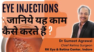 आँखों में INJECTION काम कैसे करते हैं [upl. by Weixel807]