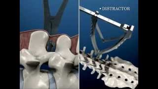 Interspinous device  HEKTOR® of BM Korea [upl. by Alhahs]