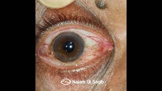 IntorsionExtorsion Of the Globe after Peribulbar Anesthesia upon attempted Extraocular movements [upl. by Matronna690]