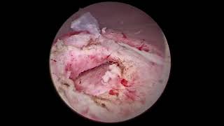 INCISION OF URETEROCELE [upl. by Eseryt]