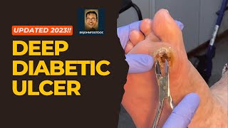 How to Cure Deep Diabetic Ulcers Fast [upl. by Grosberg]