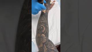 How to remove a Permanent Tattoo Laser vs Tattoo ☠️ [upl. by Oribel]